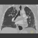 Sclerodermia, pulmonary fibrosis, UIP, fibrosis, oesophagus: CT - Computed tomography